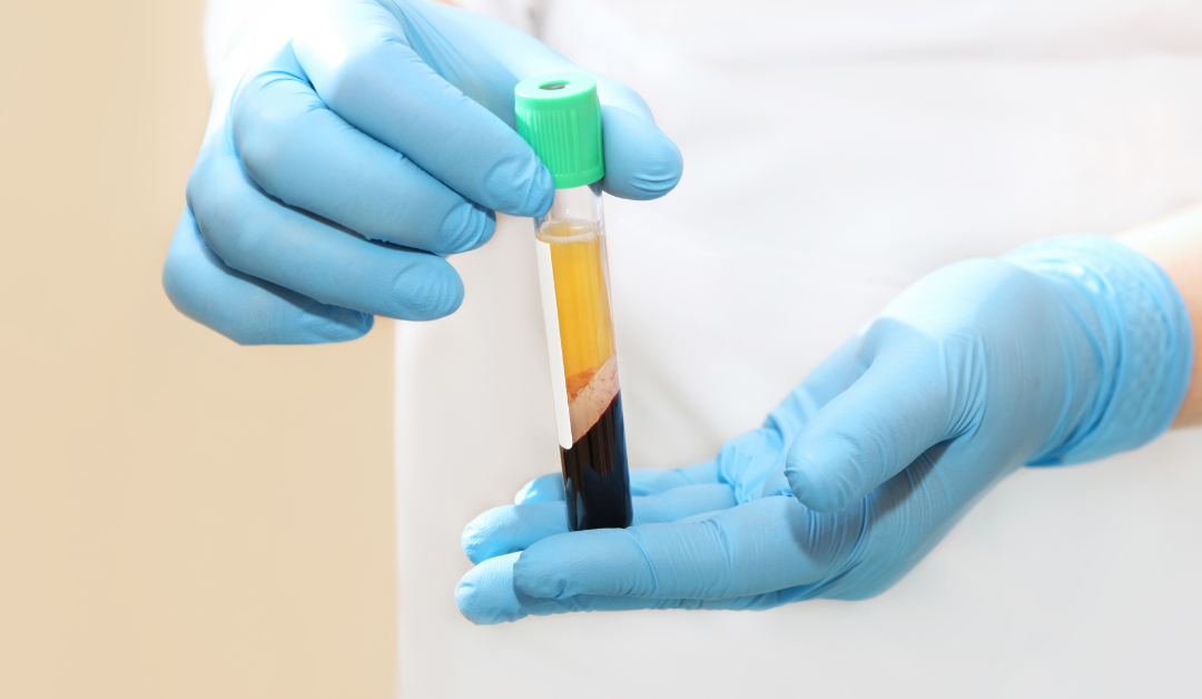 Platelet Rich Plasma Injections for Arthritis