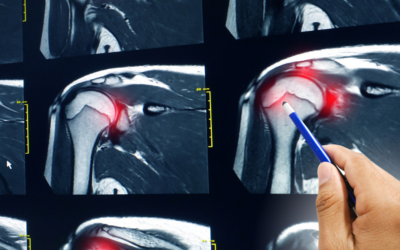Comprehensive Guide to Alternatives for Rotator Cuff Surgery