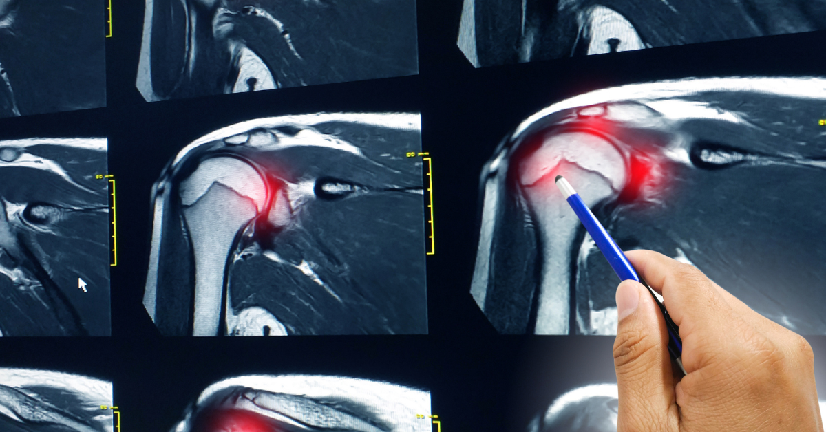 Alternatives for Rotator Cuff Surgery