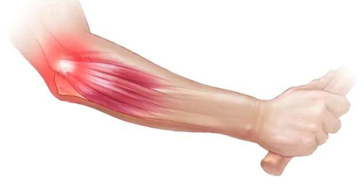 Tennis Elbow Injury Treatment