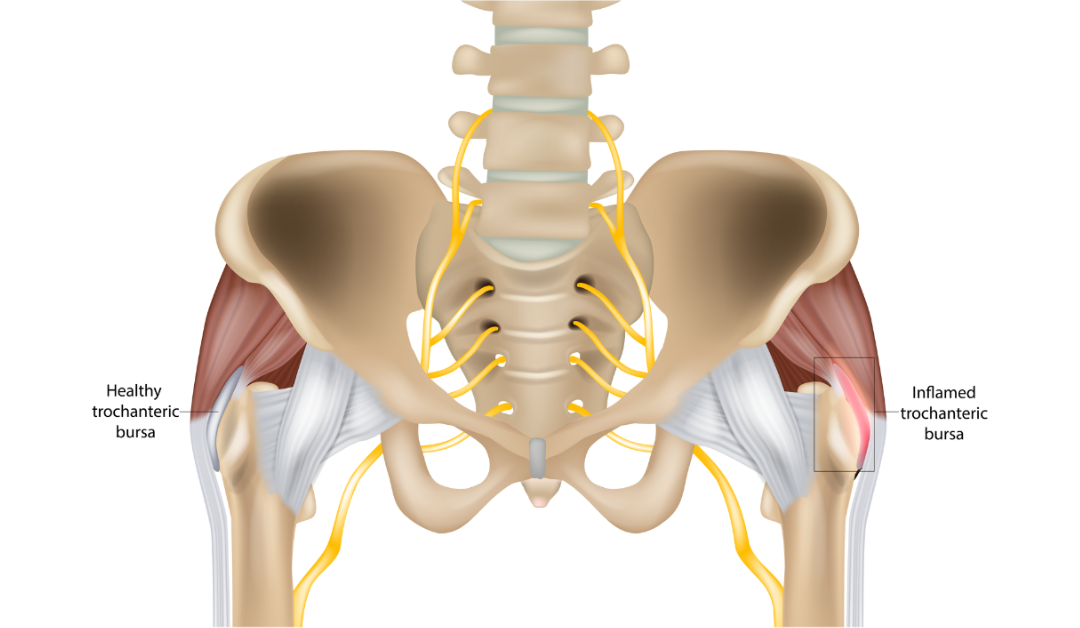 Treatment for Bursitis in the Hip