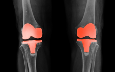 Beyond Surgery: Exploring Alternative to Knee Replacements