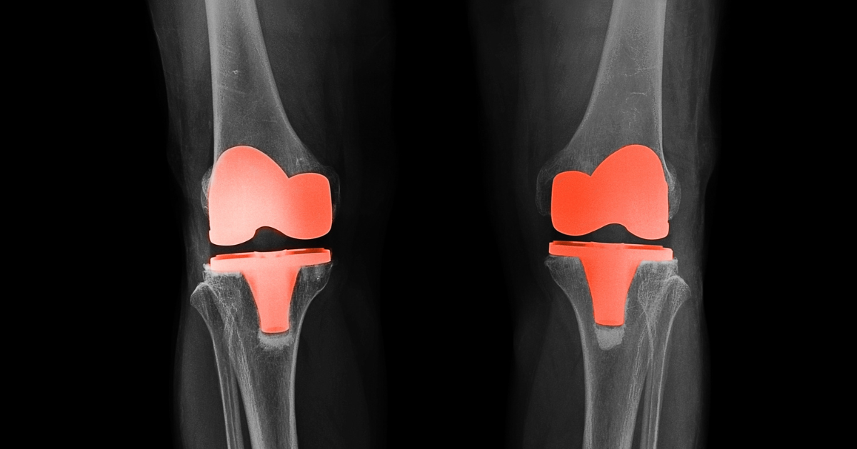 Beyond Surgery: Exploring Alternative to Knee Replacements