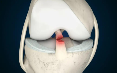 Exploring the World of ACL Non-Surgical Treatment: What You Need to Know