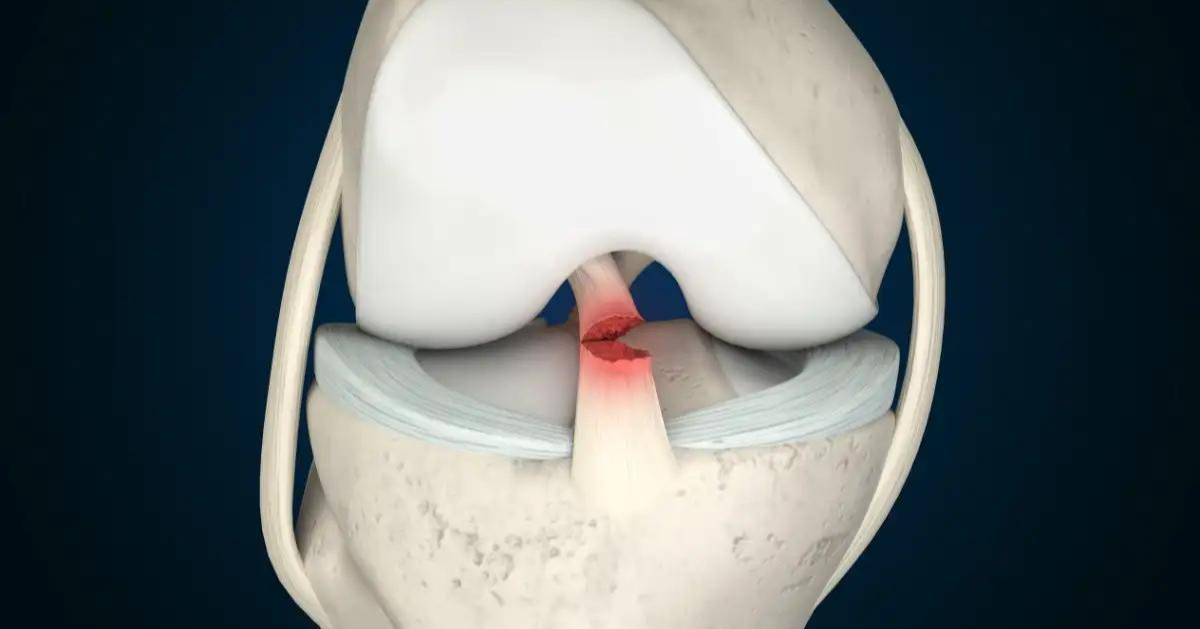 ACL non-surgical treatment