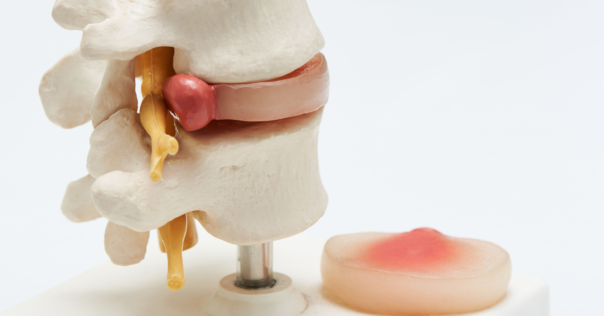 Exploring the Potential of Stem Cell for Herniated Discs