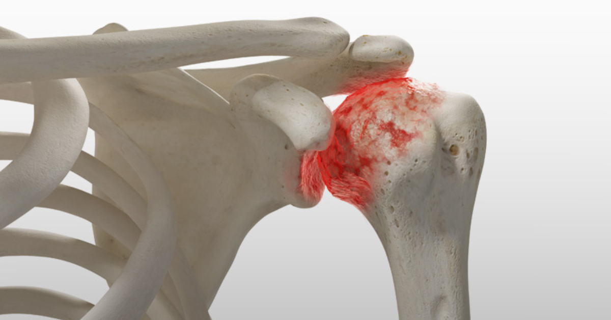 Exploring Effective Treatment for Osteoarthritis in Shoulder